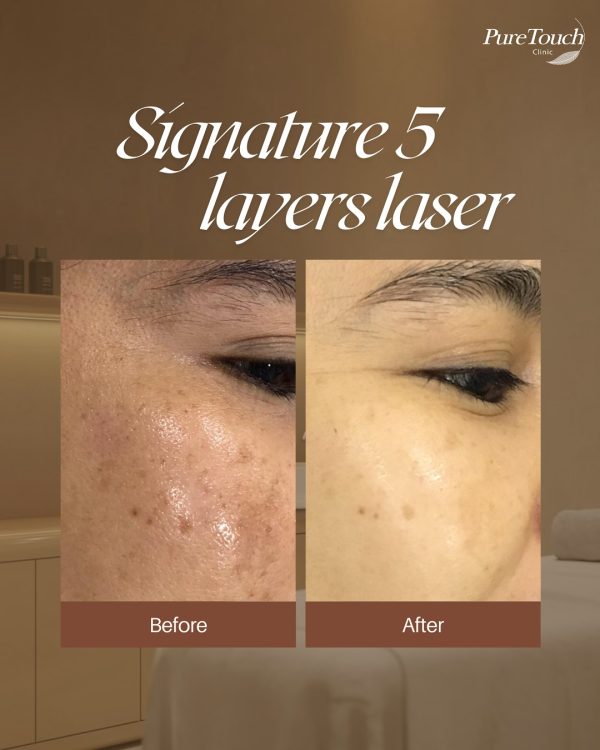 Signature 5 layer laser before after image Signature 5 layer laser before after image