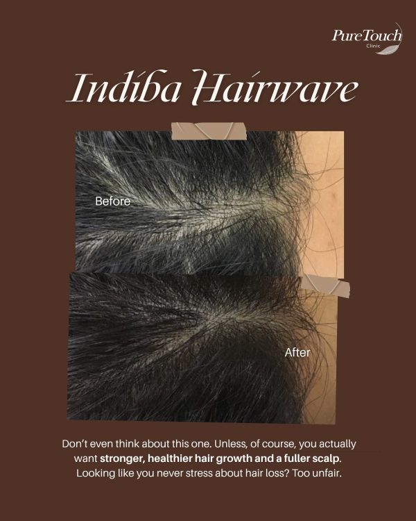 indiba hair indiba hair