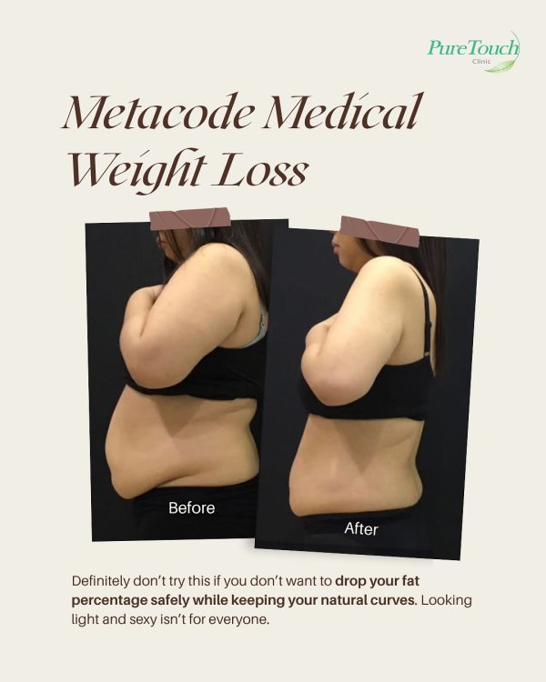 metacode medical weight loss metacode medical weight loss