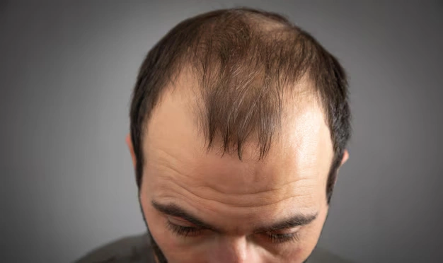 caucasian-man-hair-loss-problem_220873-19856