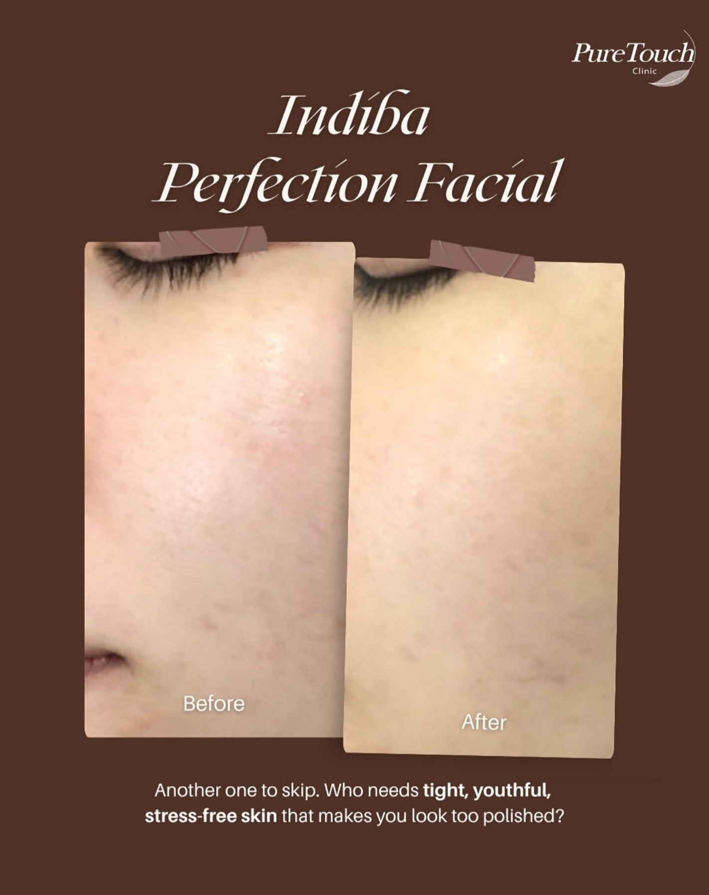 indiba facial