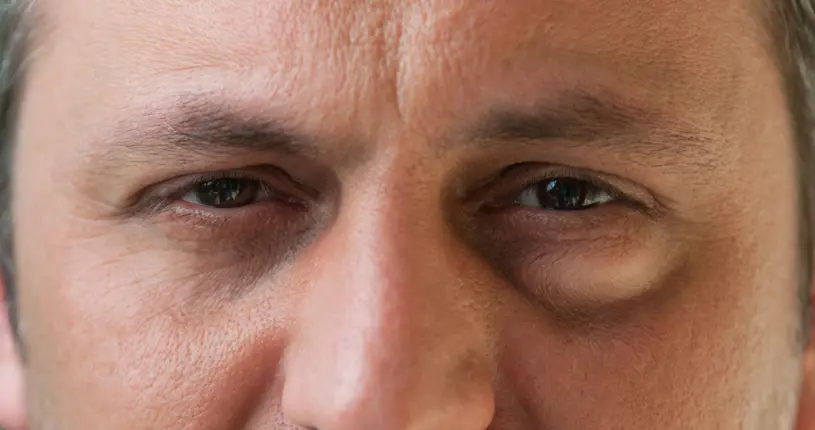 eye bags
