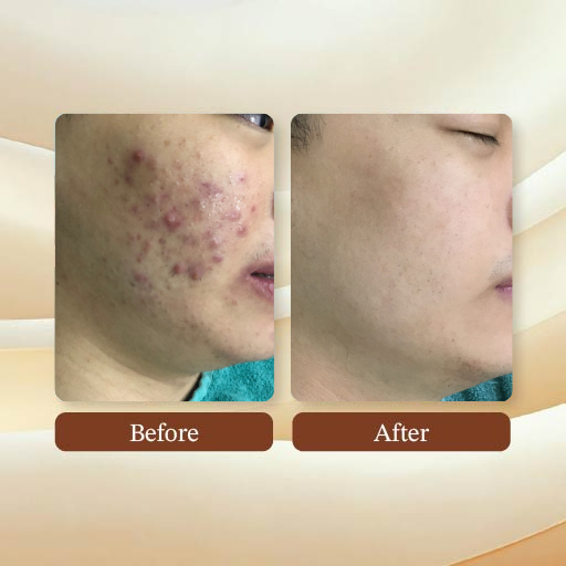 Acne Treatment Result