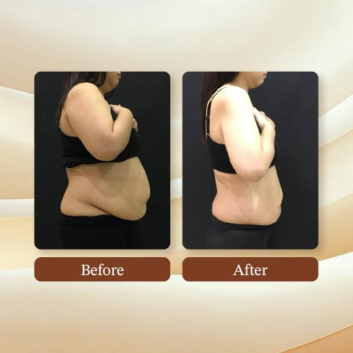 Metacode Slimming Result