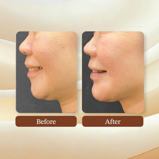 Face Lift Treatment Result