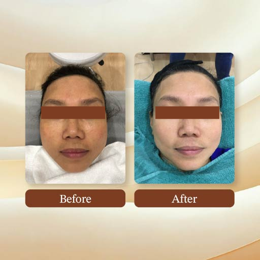 Laser Treatment Result