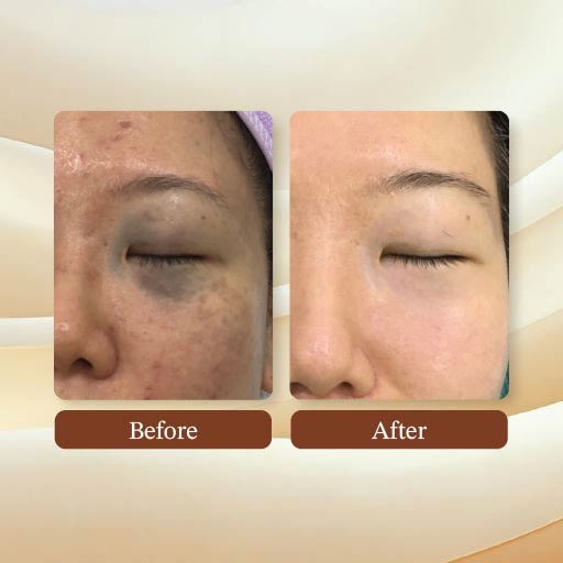 Laser Treatment Result
