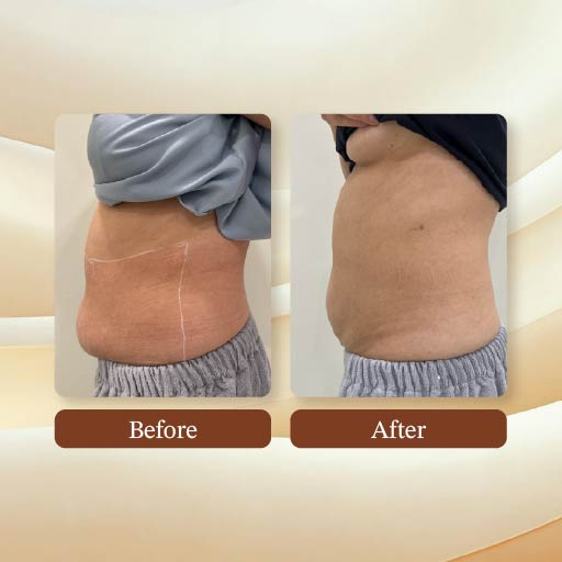 Slimming Treatment Result