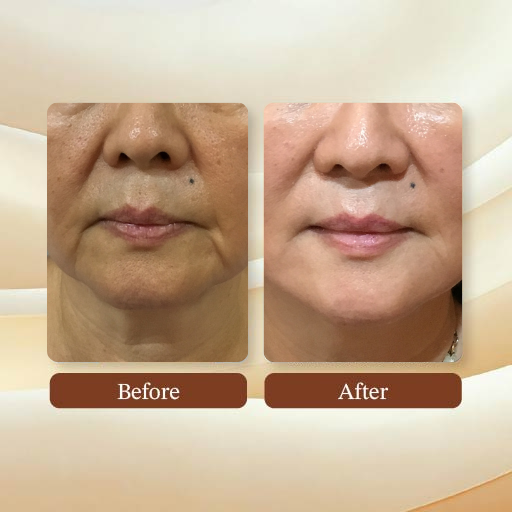 Face Facelift Result