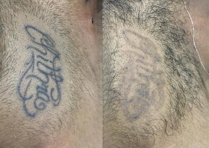 Tattoo Removal Before and After