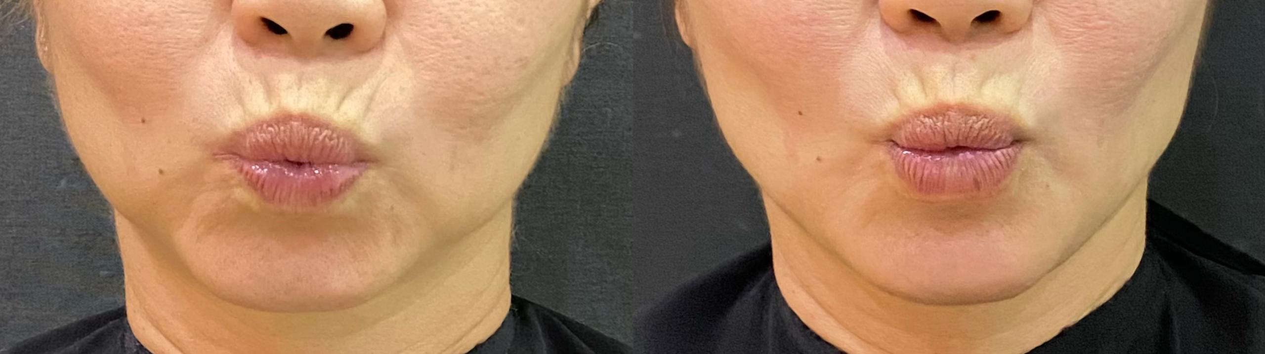Liquid Facelift Before and After 3