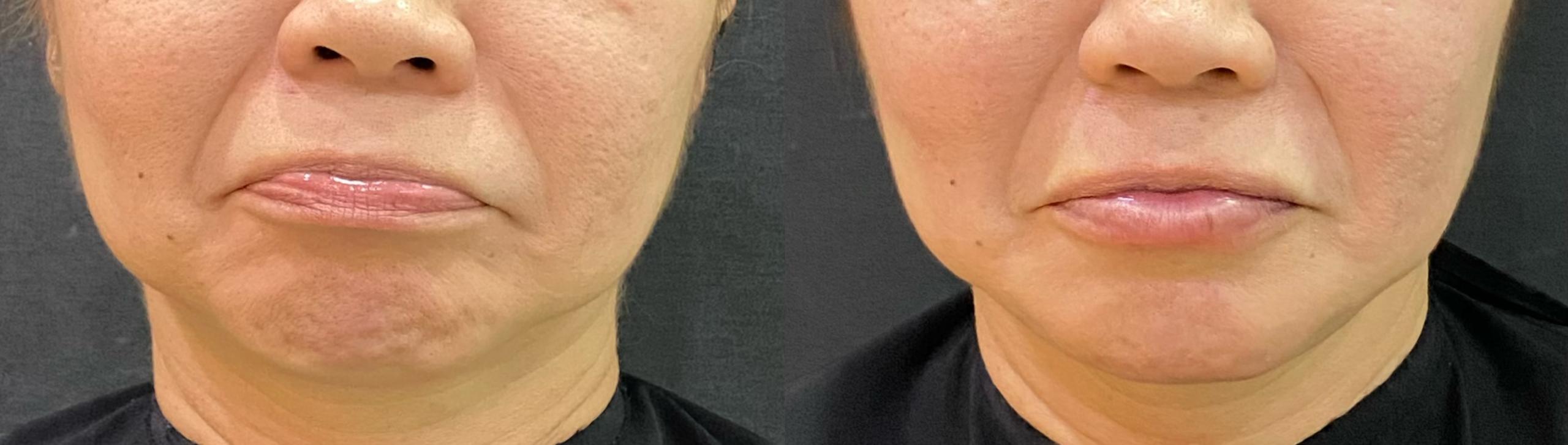 Liquid Facelift Before and After 4