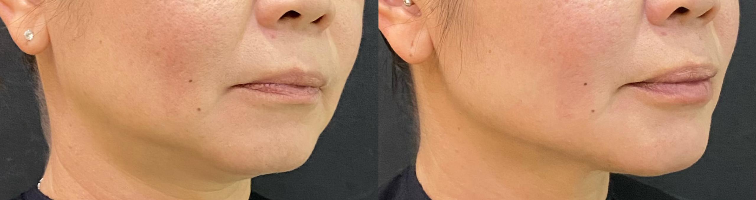 Liquid Facelift Before and After 5