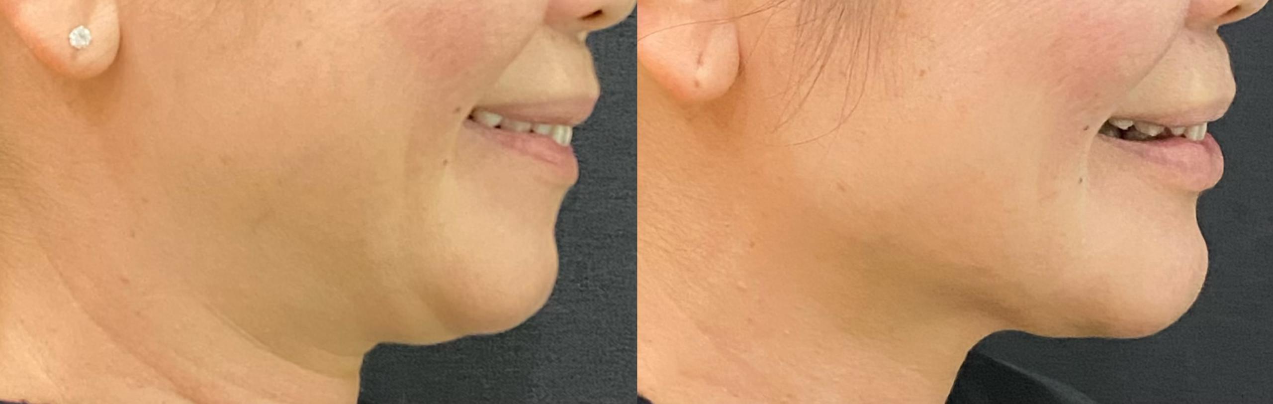 Liquid Facelift Before and After 7