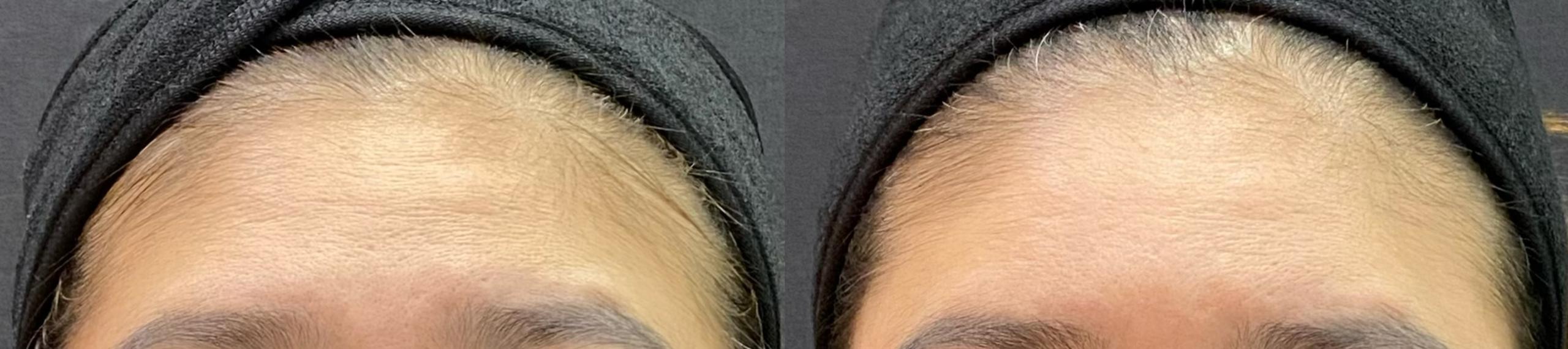 Liquid Facelift Before and After 1
