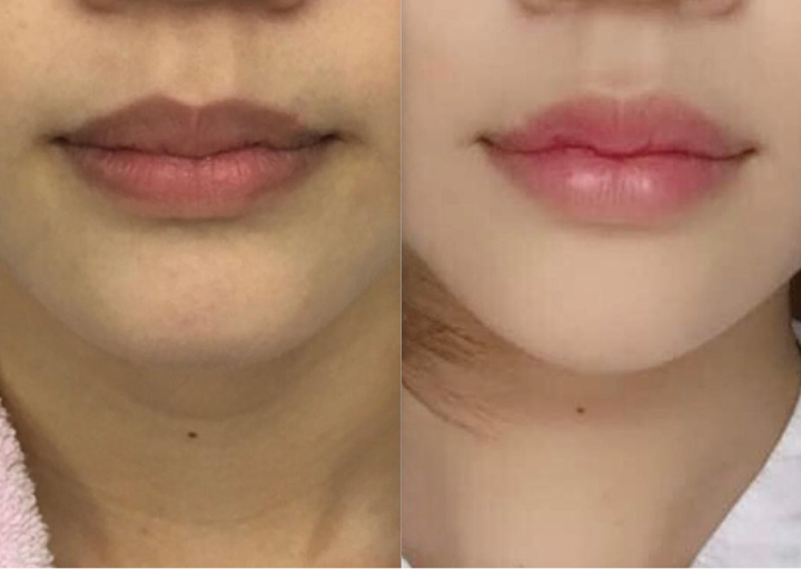 Lip Lightening Before and After