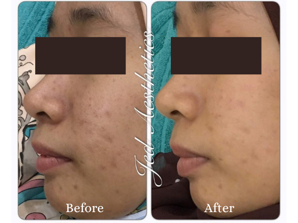RF Microneedling Before and After Result 1