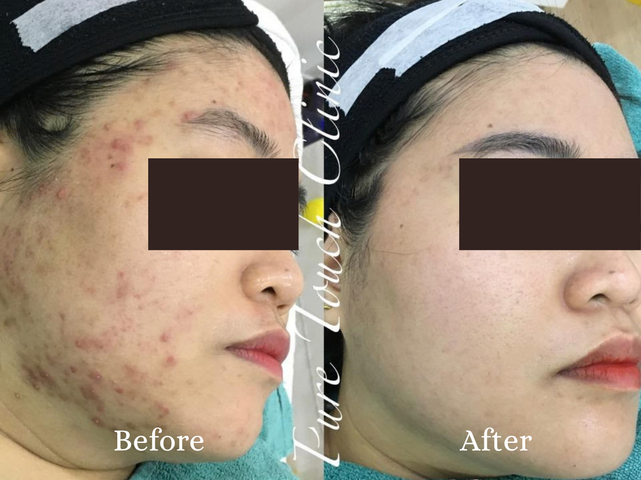 Chemical Peel Before and After Result 2