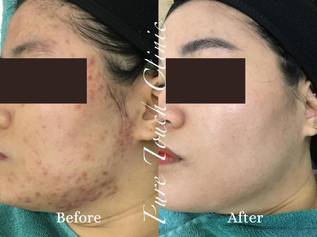 Chemical Peel Before and After Result 1