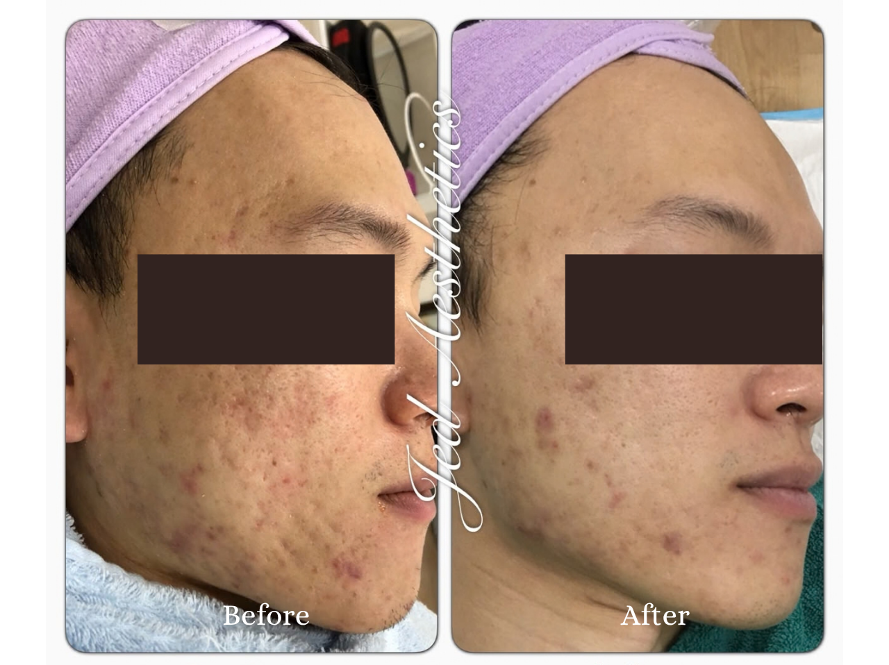 PRP Treatment Before and After Result 3