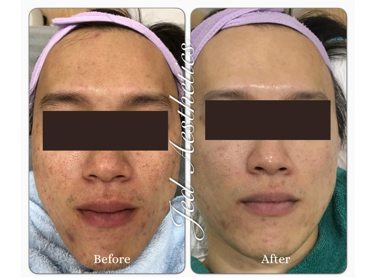 PRP Treatment Before and After Result 2