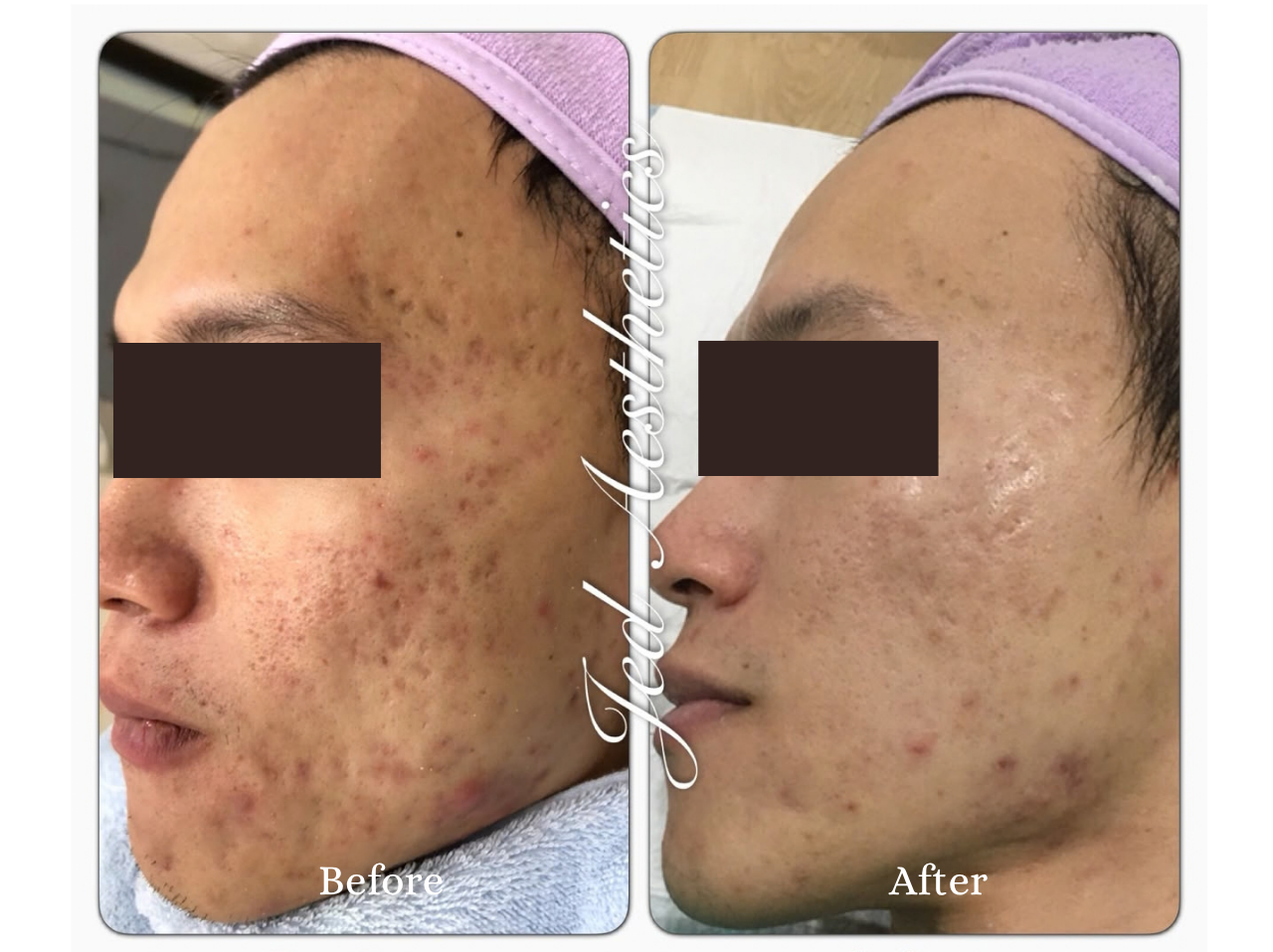 PRP Treatment Before and After Result 1