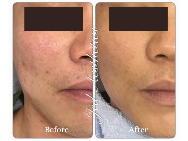 Scar Treatment Before and After Result 1
