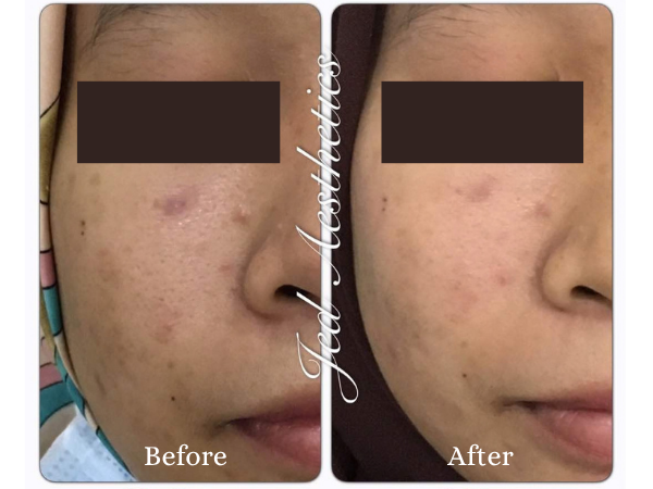 RF Microneedling Before and After Result 2