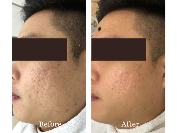 Scar Treatment Before and After Result 2