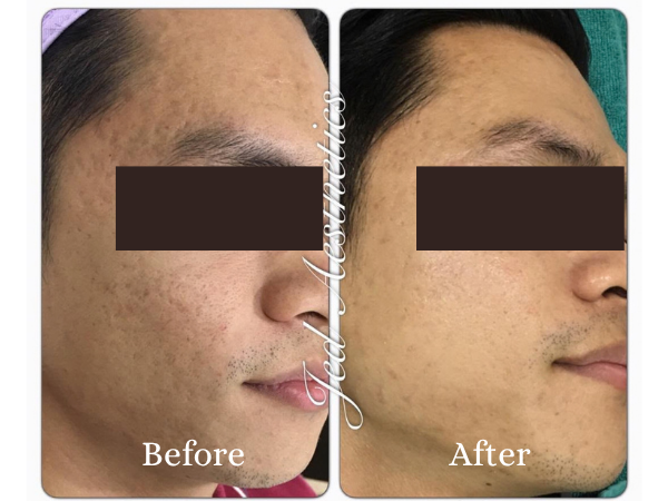 Scar Treatment Before and After Result 3