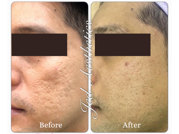 Scar Treatment Before and After Result 4