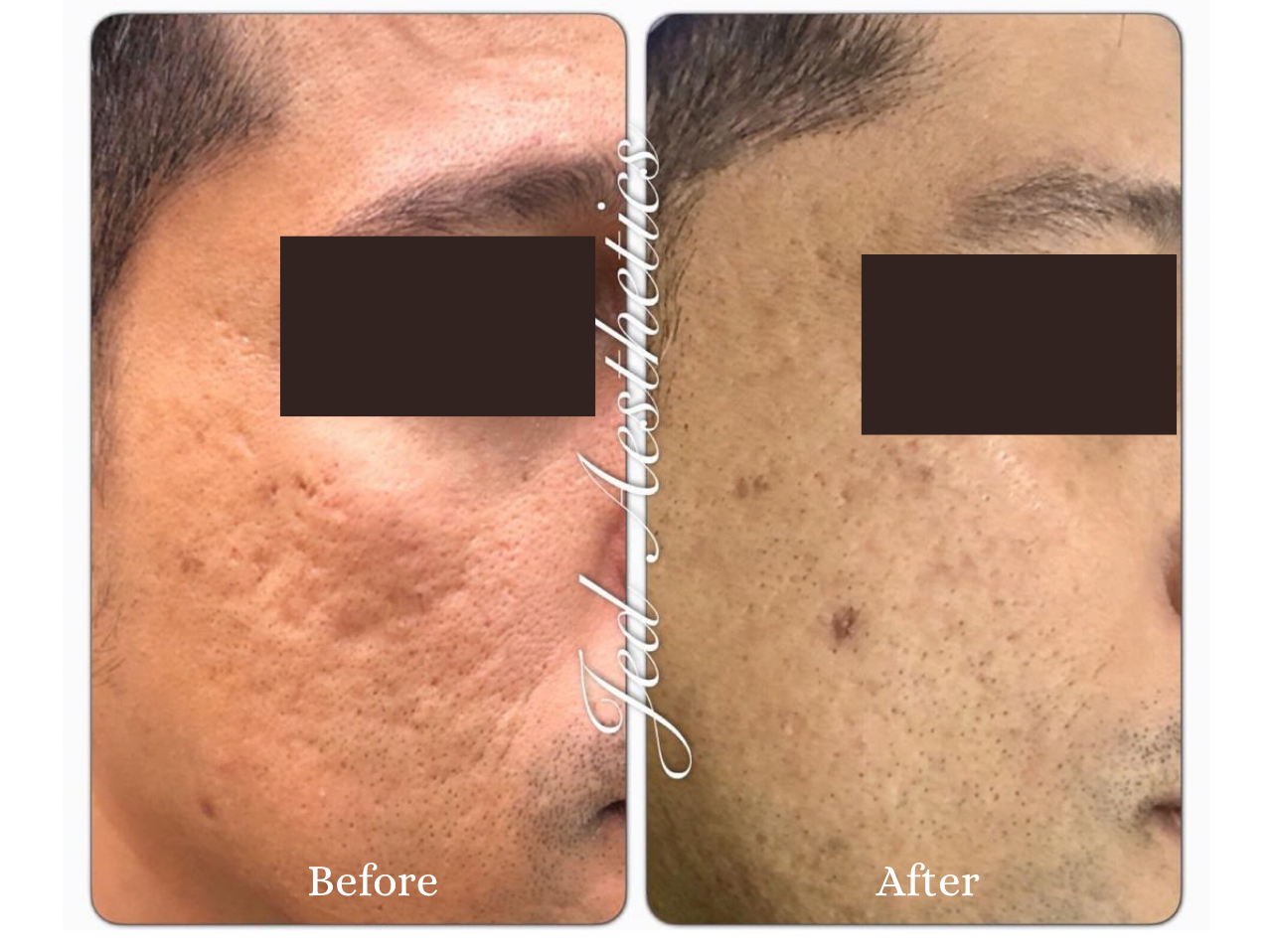 Scar Treatment Before and After Result 5