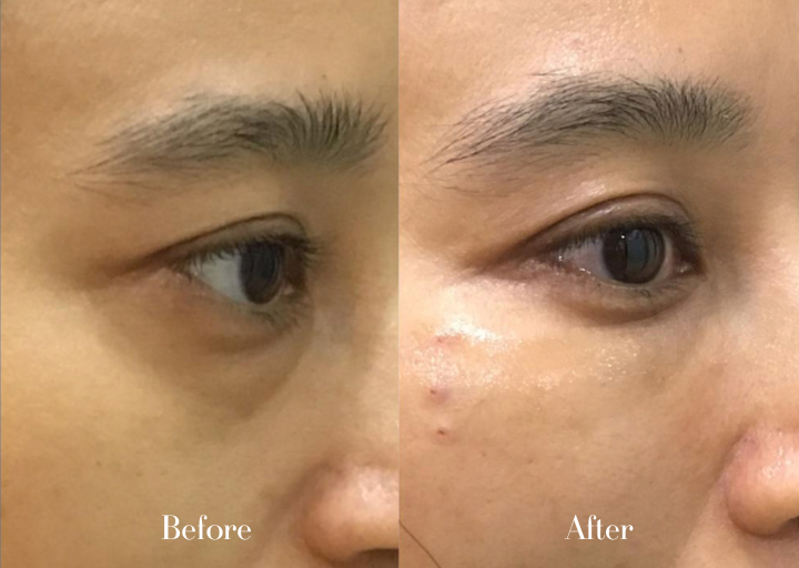Thread Lift Before and After Result 3