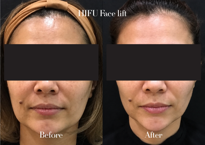 HIFU Before and After Result 1