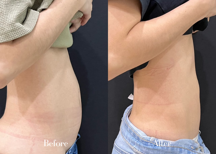 Body Contouring Before Result 1