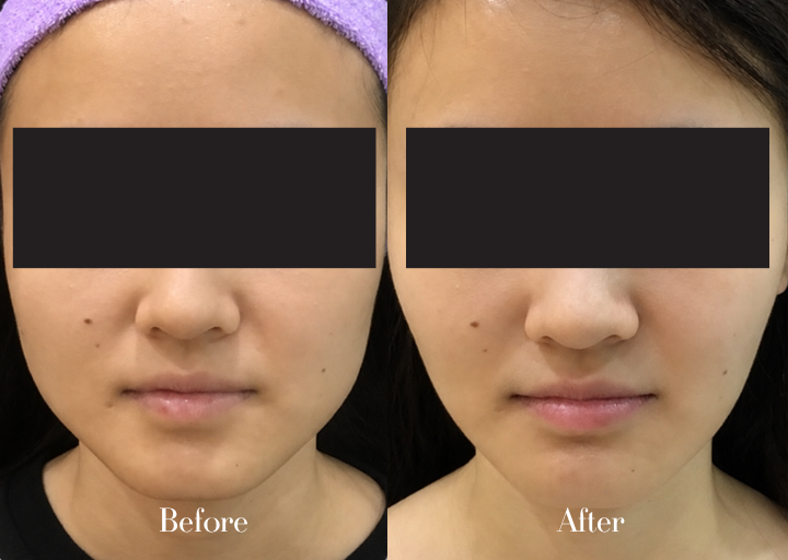 BTA Treatment Result 1