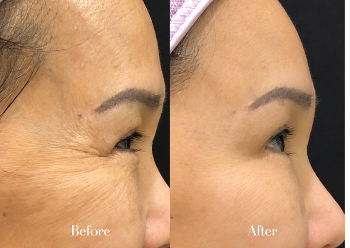 BTA Treatment Result 2