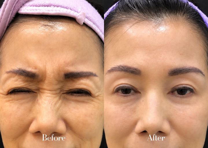 BTA Treatment Result 3