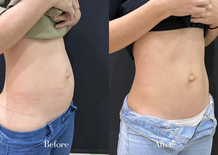 Body Contouring After Result 1