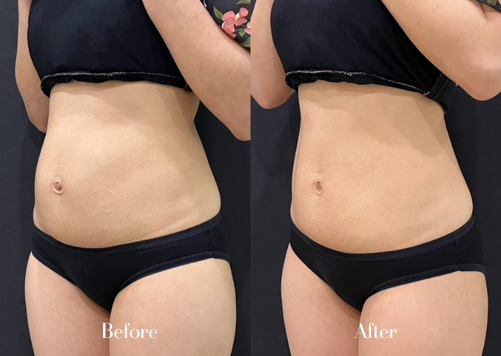 Body Contouring Treatment Result