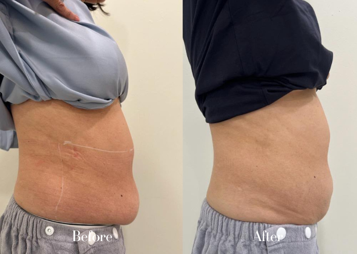 Body Contouring After Result 2