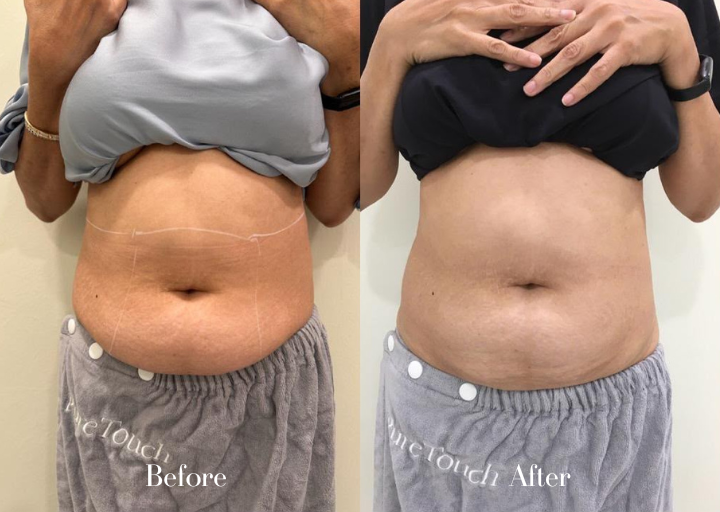 Body Contouring Before Result 2