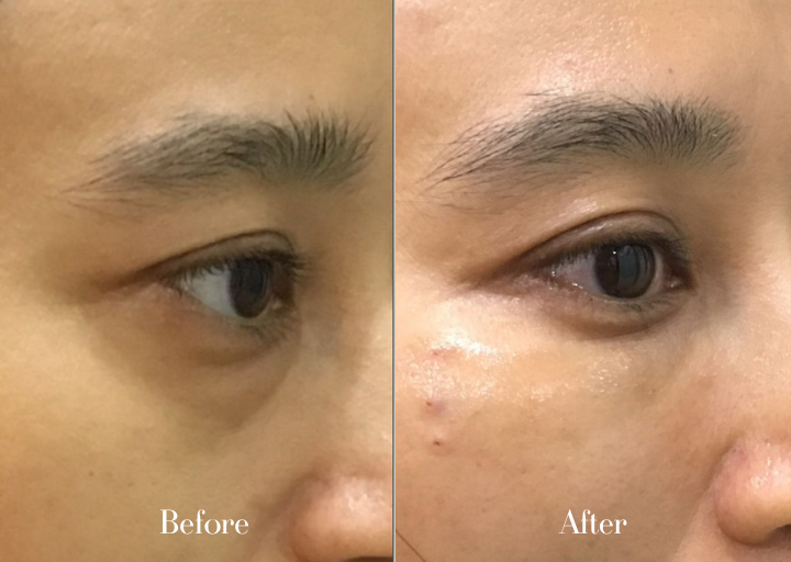 Before and After
