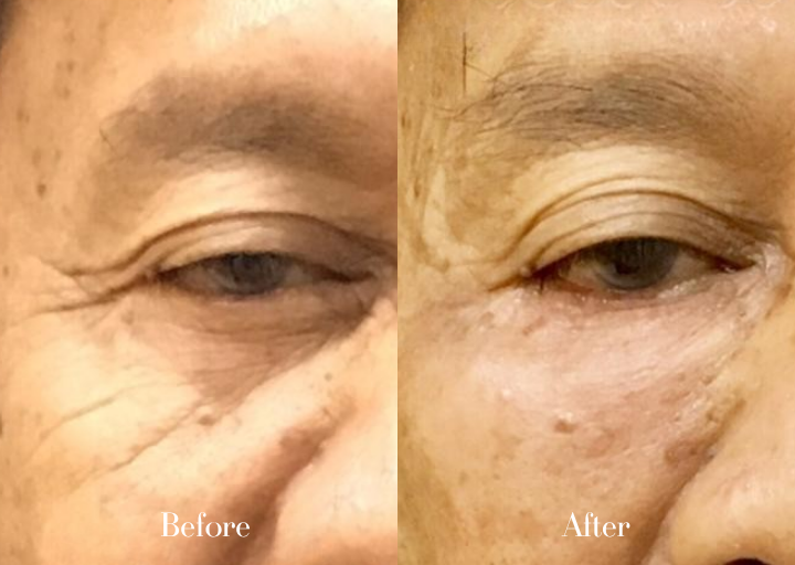 Before and After