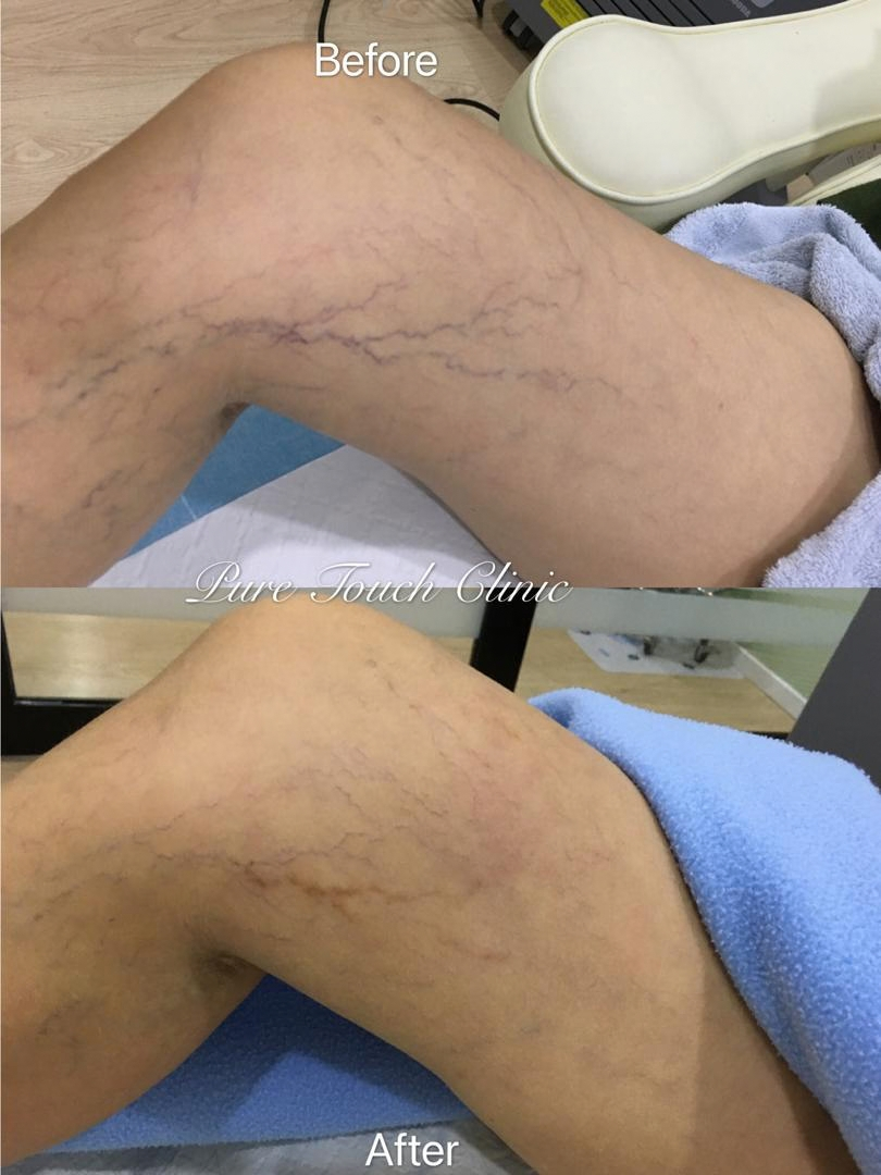 Sclerotherapy Treatment Before and After Result 1