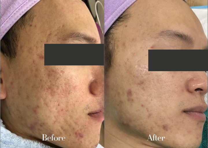 Acne Treatment Result 2 Before