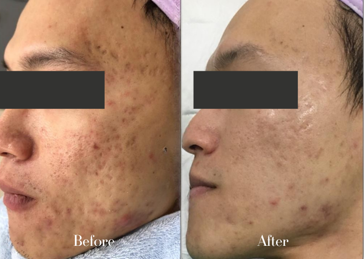 Acne Treatment Result 2
