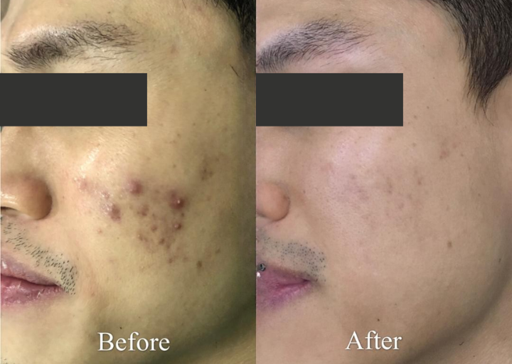 Pore Refining Before