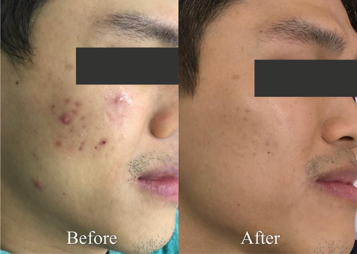 Pore Refining Result