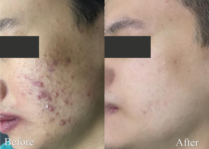 Pore Refining Before